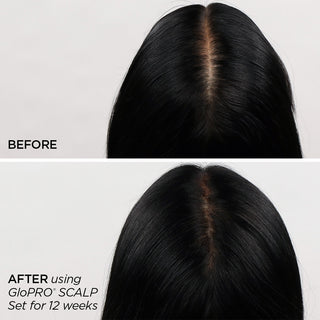 GloPRO Scalp B&A